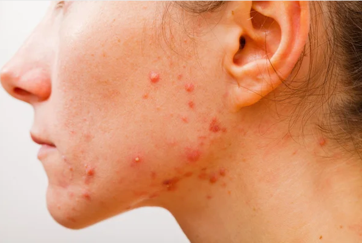 Post-Pill Acne